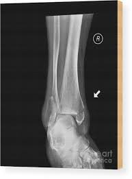 Image result for Ankle XRay