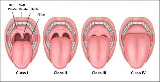 Image result for Uvulitis