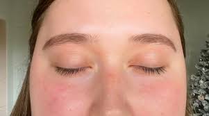 Image result for ekzema face