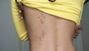 Maybe you would like to learn more about one of these? Picaduras De Chinches De Cama Fotos Tratamiento Y Prevencion