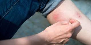 Sepsis may progress to septic shock. Krankenkasse Warnt Immer Haufiger Schwere Entzundungen Durch Muckenstiche Kolnische Rundschau