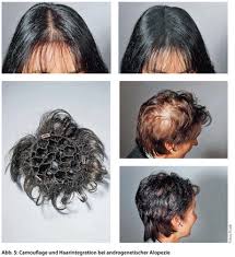 Manche männer sind da durchaus experimentierfreudig. Haarausfall Bei Frauen Ursachen Und Behandlung Allgemeinarzt Online