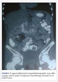 Colon cancer (or colorectal cancer or bowel cancer) affects the large intestine or in the rectum. Carcinoma Of The Colon In A Child Mdedge Hematology And Oncology