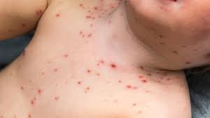 A couple of days before this body rash may appear. What Do Chicken Pox Look Like When They First Come Out Anggi Herbal