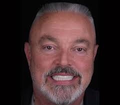 Full mouth rehabilitation with dental implants. It’s important to stress  that maintenance of dental implants are critical for long term success.  This includes:, 💡Patient Education, 💡Hygiene ...