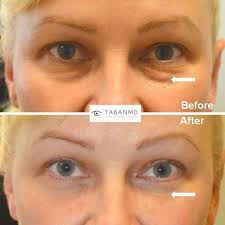 Blepharoplasty In 2020 Youthful Eyes Eye Bag Surgery Under Eye Bags