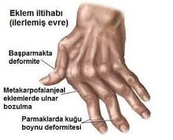 Eldeki Eklem Yangisi Icin 7 Tedavi Yontemi Saglik Ve Spor Aktiviteleri Artrit Dogal Tedaviler Ve Bitkisel Ilac