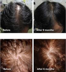 The researchers concluded that prp injections reduced the rate of hair loss, increased the diameter of individual hairs, and boosted the overall density of hair growth in key areas of the scalp such as the vertex, hairline, and temples. How Effective Is Platelet Rich Plasma Prp For Hair Restoration Doctor Kedy Jao