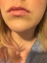 What is the fastest healing piercing? How Can I Close My Old Lip Ring Hole Photo