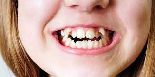 Maybe you would like to learn more about one of these? Apa Fungsinya Gigi Taring Rohaya Dental Surgery Facebook