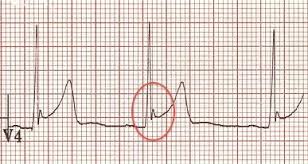 Image result for Early Repolarization