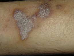 Hypertrophic (thick, hyperkeratotic plaques) actinic (young adults or children with lichen planus on sun exposed areas occurring during the spring and summer seasons) pigmentosus (lesions are brown, on the face and neck, more common in south asia, frequent intertriginous involvement) ulcerative (palmoplantar ulcerations) Lichen Planus Dermnet Nz