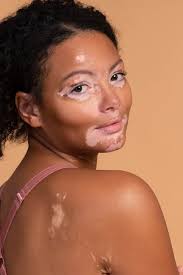 Image result for Vitiligo