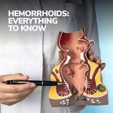 Hemorrhoids: Everything to Know | Gastroenterology Orlando