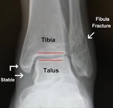 Pin On Broken Ankle