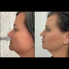 One year of consistency, care, and small changes can make such a  difference. ✨ These photos are taken a year apart. Over time, Christy has  added in gradual treatments—cheek and lip filler,