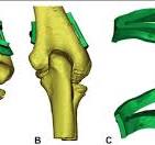 Design of osteotomy guide plate. a Positive view. b Back ...