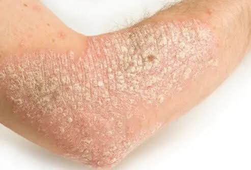 Psoriasis skin patch