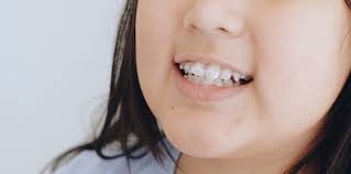 Maybe you would like to learn more about one of these? Cara Praktis Pemasangan Behel Yang Aman Dan Standar Dari Opaldental Dokter Gigi Jogja Project Reoco