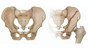 Image result for Fracture