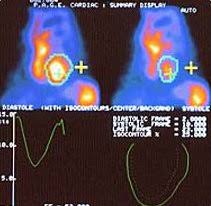 Image result for Nuclear Ventriculogram