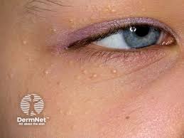 Image result for milium cyst on eyelid