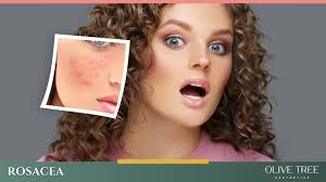 Effective Rosacea Relief: IPL and Venus Viva™ Treatments Plus Skincare  Strategies