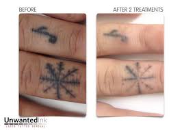 The tattoo will remain visible, however, and skin irritation and other reactions are possible. Black Ink Tattoo Removal
