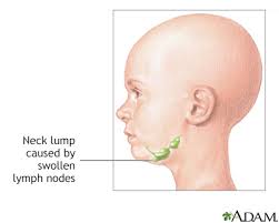 The tumors often start in the mouth and spread to the lymph nodes, which is when they become visible on your neck. Neck Lump Information Mount Sinai New York