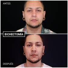 La bichectomía es la operación de cirugía estética que extrae las bolas de bichat. Bichetomia Ceme Centro Europeo Medico Estetico