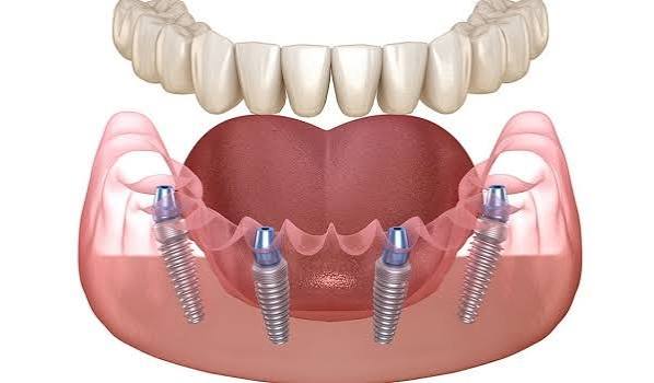 Cấy ghép Implant All-on-4
