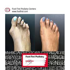 Cosmetic Bunion Hammertoe Surgery Hammer Toe Surgery Corn On Toe Smelly Feet Remedies