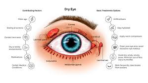Image result for Dry Eye