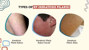 Image result for Keratosis pilaris