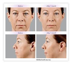 The price tag of juvederm voluma can differ significantly between two treatment providers. Juvederm Voluma Vs Juvederm Ultra Xc Cosmeticare