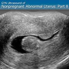 Gyn Ultraschall Bei Nicht Schwangerem Abnormalem Uterus Teil Ii Fortgeschrittenes Klinisches Modul Sonosim