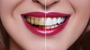 Helps strengthen teeth and fights cavities. How Long Does Teeth Whitening Last Revitalise Dental Centre