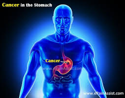 Most cases of stomach cancers are gastric carcinomas, which can be divided into a number of subtypes, including gastric adenocarcinomas. Cancer In The Stomach Causes Symptoms Stages Treatment Survival Rate