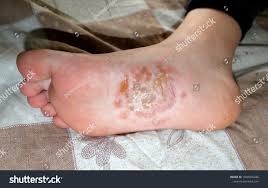 Image result for pompholyx soles of feet