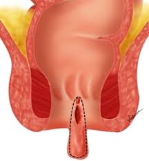 Scielo Brasil Anoplastia Com Plicoma Sentinela Para O Tratamento De Fissura Anal Cronica Anoplastia Com Plicoma Sentinela Para O Tratamento De Fissura Anal Cronica