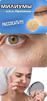 как избавиться от белых пятен на лице в домашних условиях Miliumy Prosyanka Belye Ugri Na Kozhe Kak Izbavitsya Skin Care Body Health Beauty Health