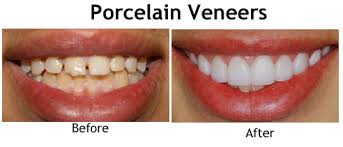 Maybe you would like to learn more about one of these? Porcelain Veneers In Nyc Central Park Dentistry
