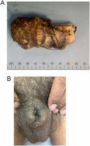 Image result for penis mycosis symptoms