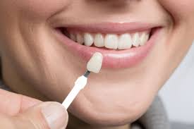 Dental Veneers - Crystal River Dental