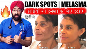 Rub raw potato on the pigmentation marks or exfoliate your face with herbal face scrub infused with fig fruit. Permanently Cure Dark Spots à¤ à¤‡à¤¯ Melasma Hyperpigmentation Or Black Marks Hindi Dr Education Youtube