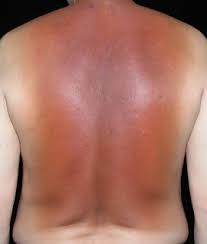 Image result for Diffuse Hyperpigmentation