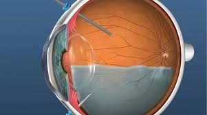 Check spelling or type a new query. Post Vitrectomy Recovery And Posturing Retina Doctor