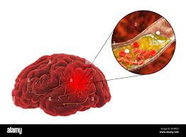 Bildergebnis für CVA