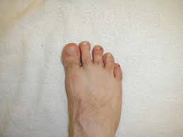 Image result for Paronychia feet