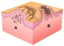 Image result for Nodule